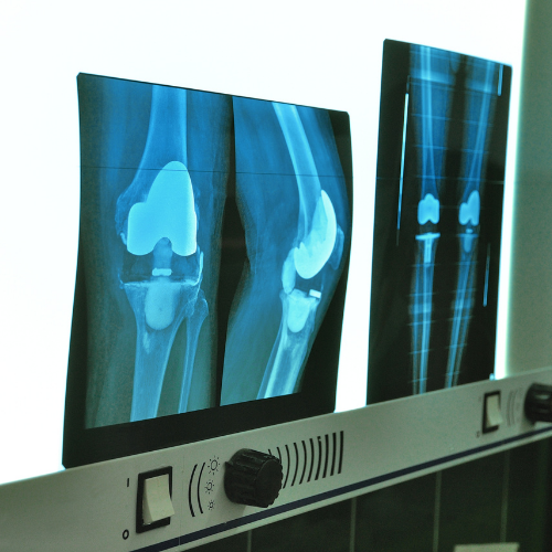 Chirurgia protesica del ginocchio a Roma Ovest